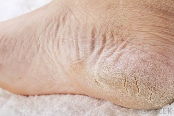 dry-cracked-feet